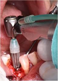 Implant Surface Decontamination: What Actually Works